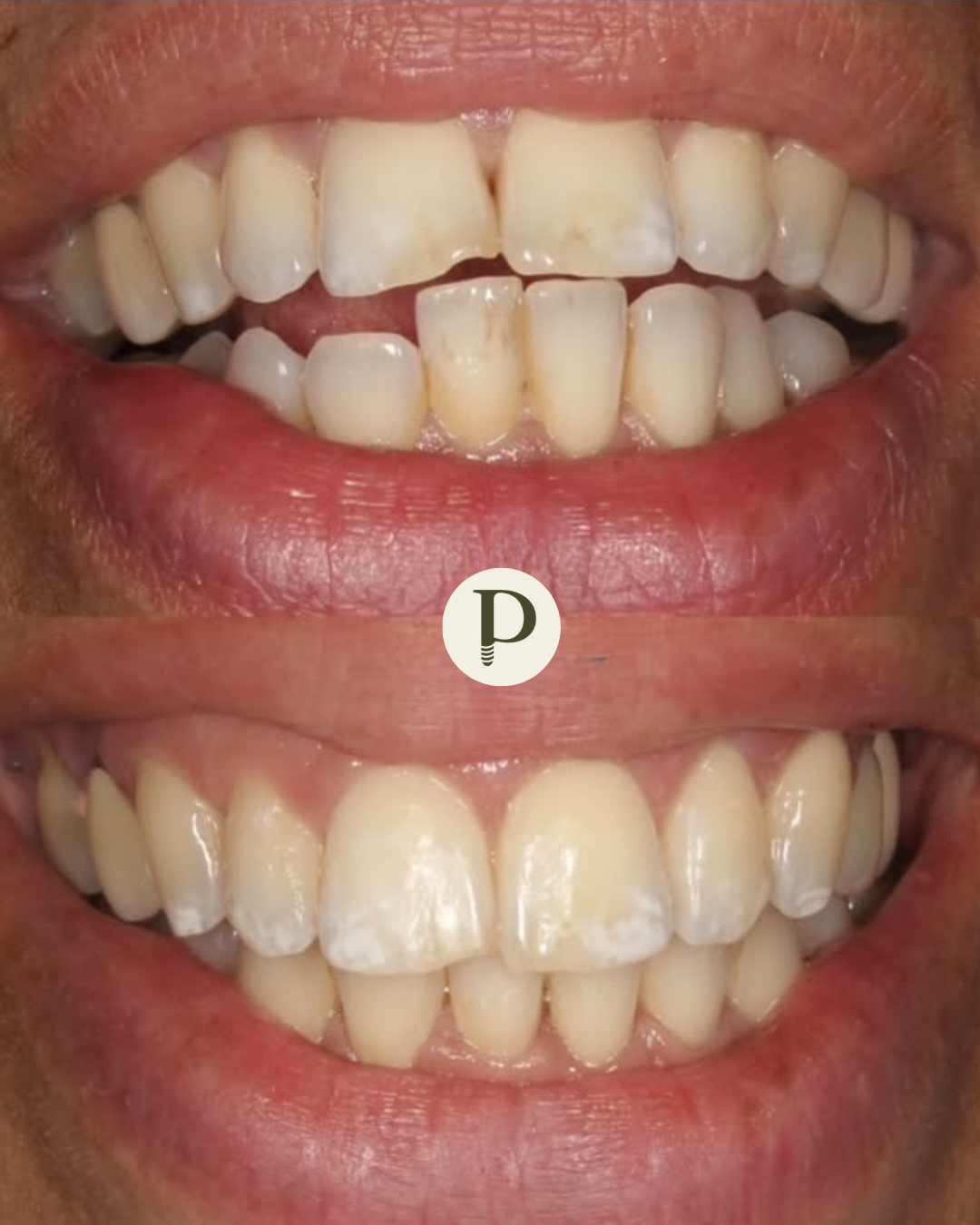 Clear aligners before and after Primadent