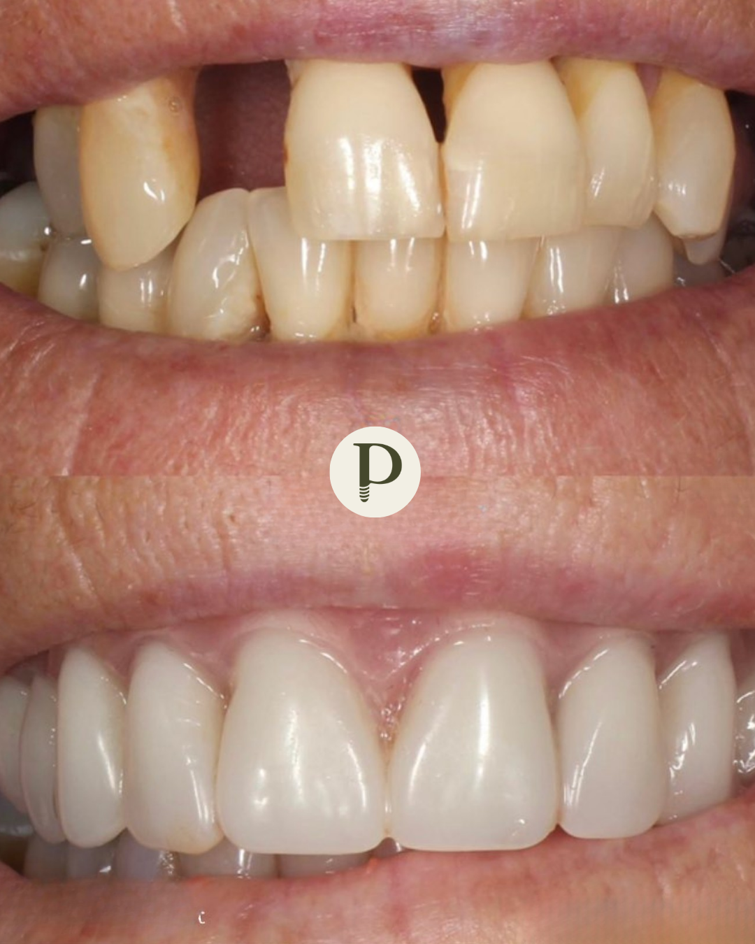 Dental implants before and after Primadent